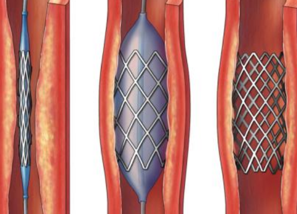 好消息！700元冠脈支架來(lái)了帶量采購(gòu)結(jié)果在甘肅省正式落地執(zhí)行